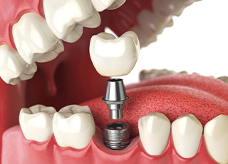 Dental implants