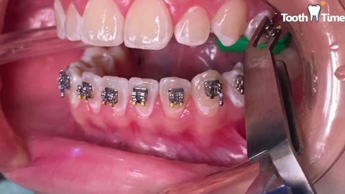 Braces and orthodontics