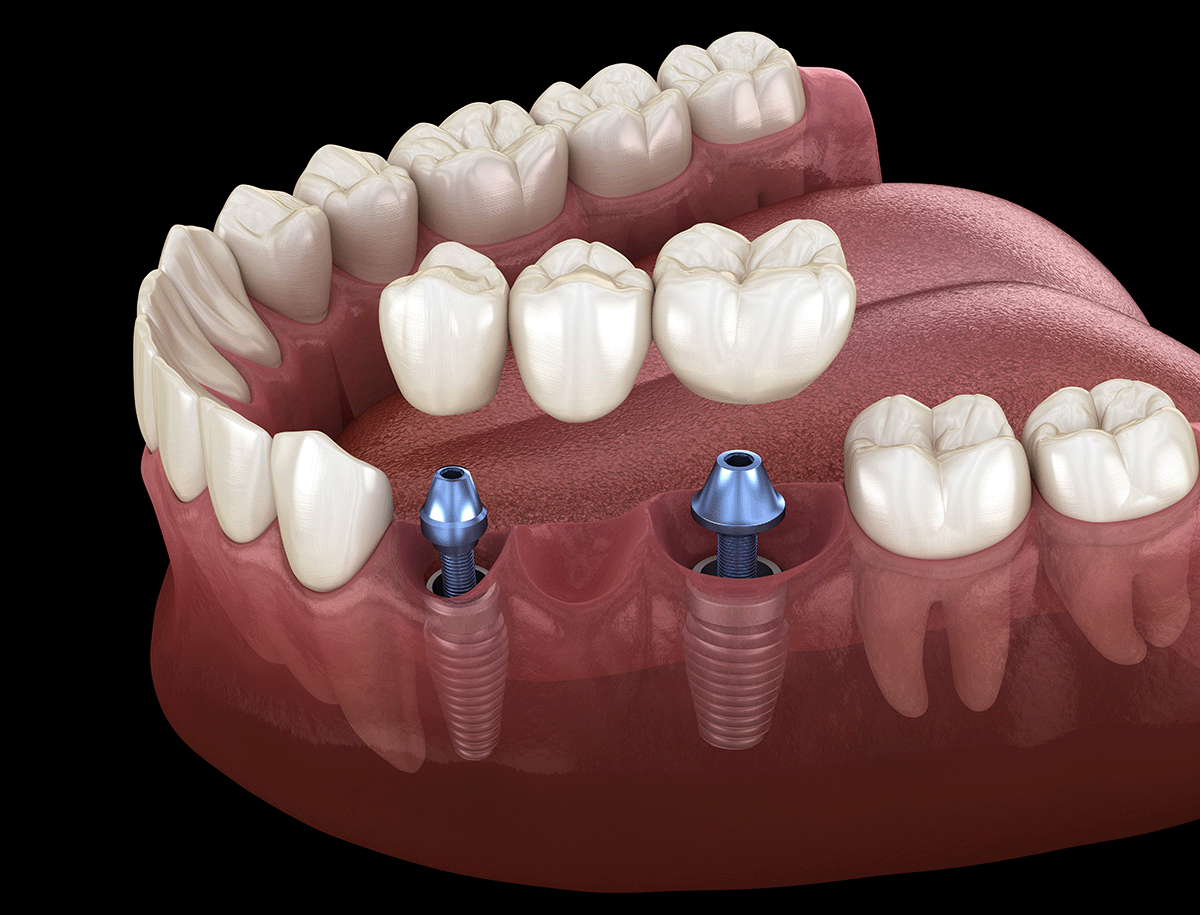 Dentures for missing teeth