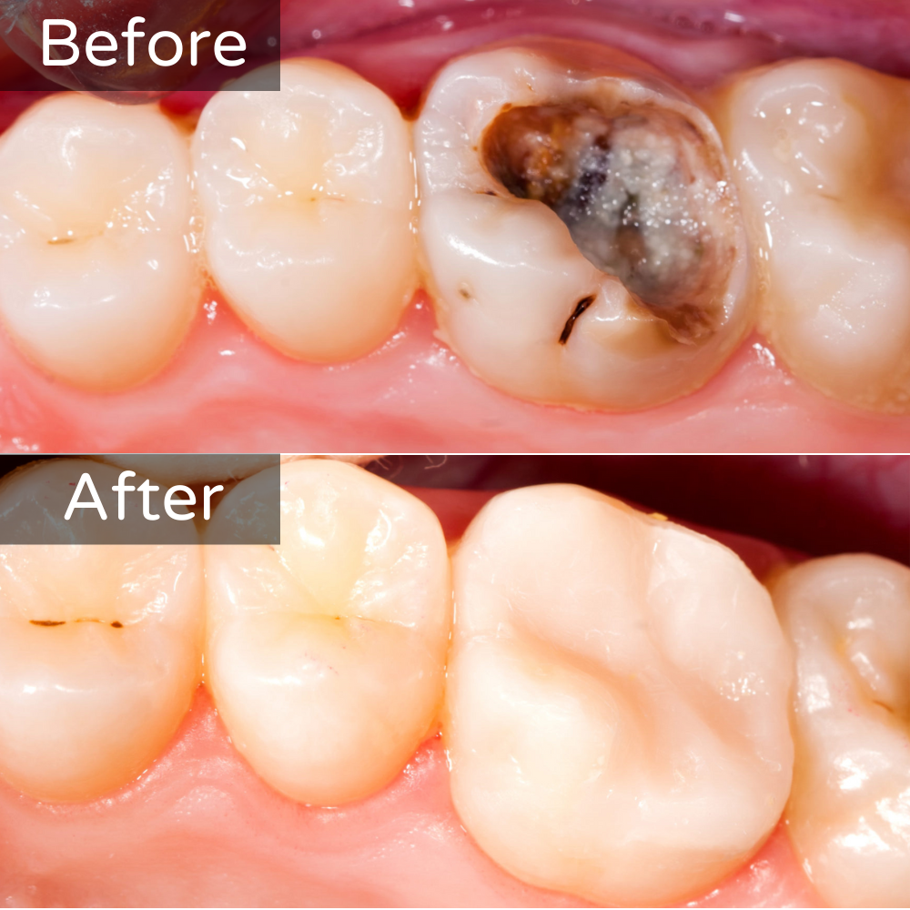 Dental fillings