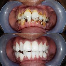Professional teeth cleaning service